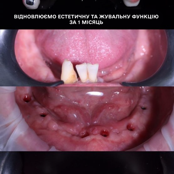 Відновили естетичну та жувальну функцію за 1 місяць