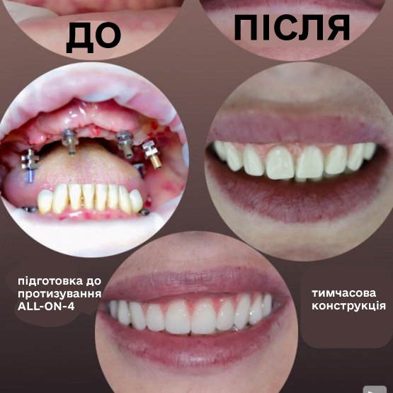 Відновили естетичну та жувальну функцію за 1 місяць