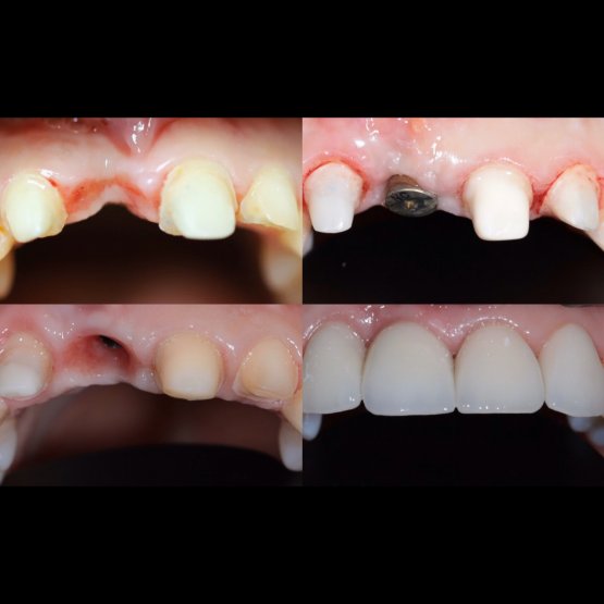 2.Установка имплнтата Straumann,протезирование керамическими коронками