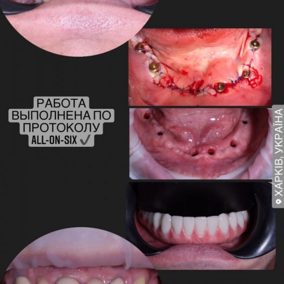 Работа выполнена по протоколу All-on-4(несъёмная конструкция) на 4-6 имплантах