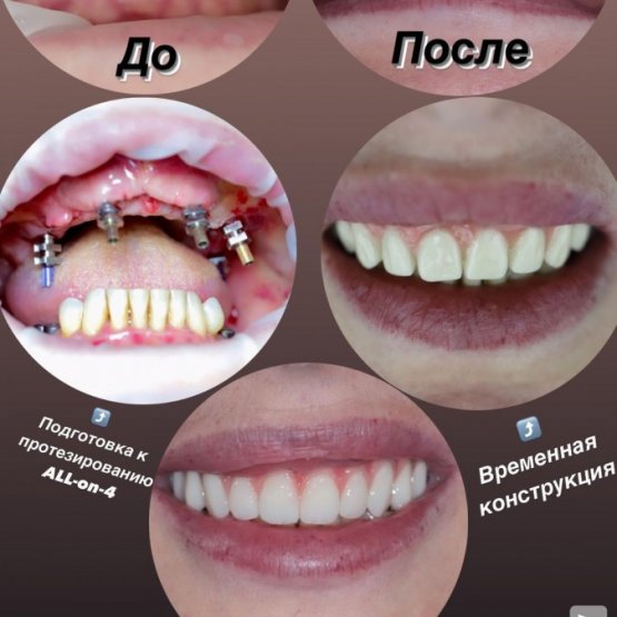 Восстановили эстетическую и жевательную функцию за 1 месяц