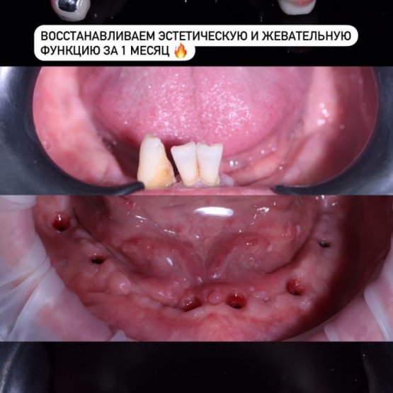 Восстановили эстетическую и жевательную функцию за 1 месяц