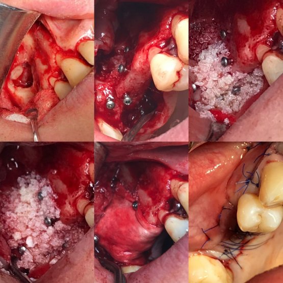 Синус-лифтинг( наращивание костной ткани на верхней челюсти)  подготовка для последующей имплантации