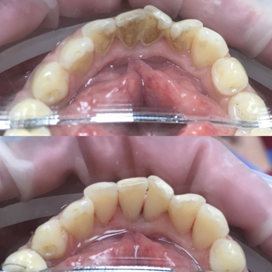Профессиональная гигиена (ультразвуковая чистка+полировка пастой+Air Flow