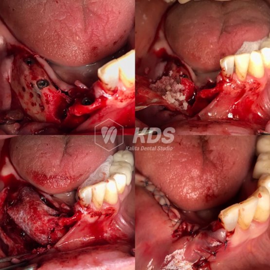 1.Костная аугментация на нижней челюсти с одномоментной установкой имплантов ICX(Германия)→