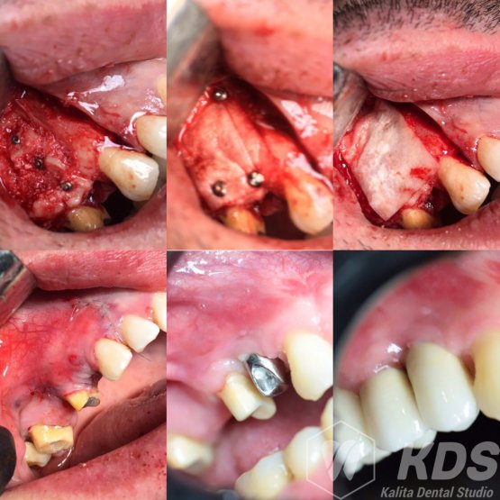 Расщепление альвеолярного гребня ,фиксация вестибулярной костной пластинки на винты + направленная костная регенирация, установка импланта ICX ,протезирование металлокерамической коронкой