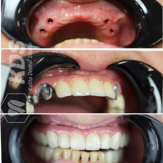 Тотальная реабилитация на верхней челюсти. Установка 6 имплантантов, протезирование с помощью металлокерамической конструкции All-in-six