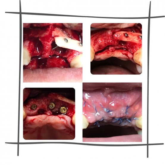 операции аутотрансплантации костного блока из ветви нижней челюсти для увеличения объема костной ткани по высоте и по ширине + имплантация Straumann(Швейцария)