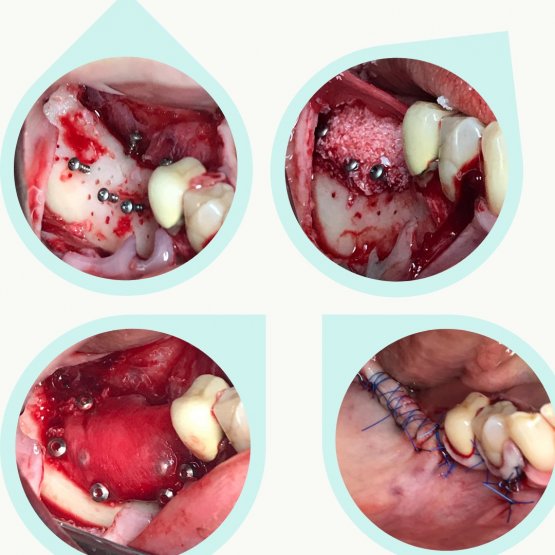 Костная аугментация на нижней челюсти (операция по наращиванию костной ткани, которая позволяет сформировать достаточное для установки имплантата ложе)