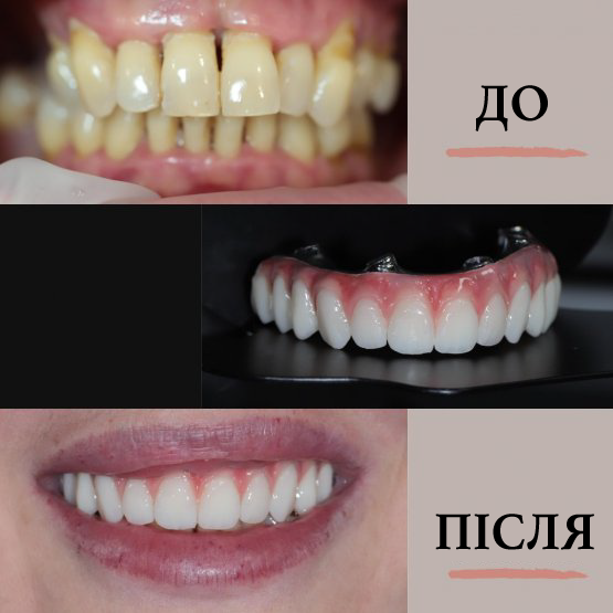 Видалення зубів + імплантація Straumann + виготовлення індивідуальної конструкції за протоколом All-in-four з композиту