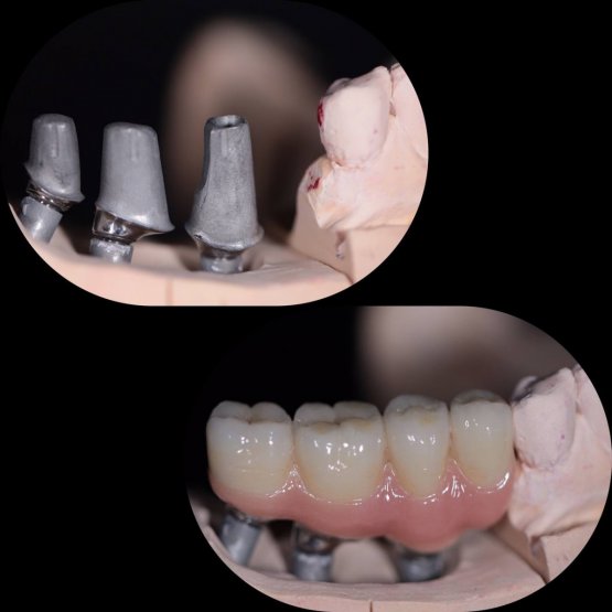 Протезирование металлокерамическими коронками на имплантах ICX(Германия) (цементная фиксация)