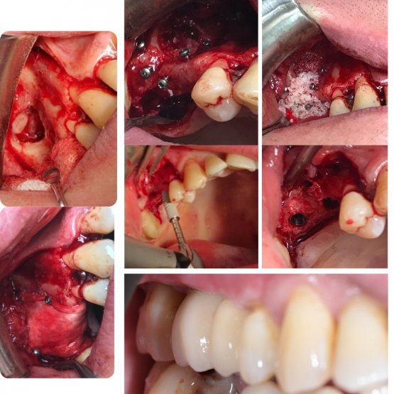 Синус-лифтинг – метод восстановления объема костной ткани на верхней челюсти с последующей установкой имплантата для восстановления жевательных зубов