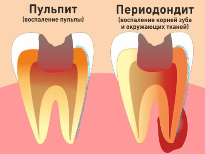 Лечение каналов Томск Заливная стоматология лоскутово томск