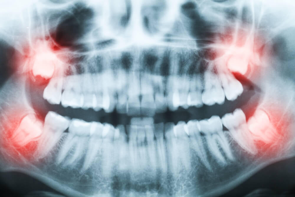 Десна после удаления зуба — сколько болит и заживает, что делать